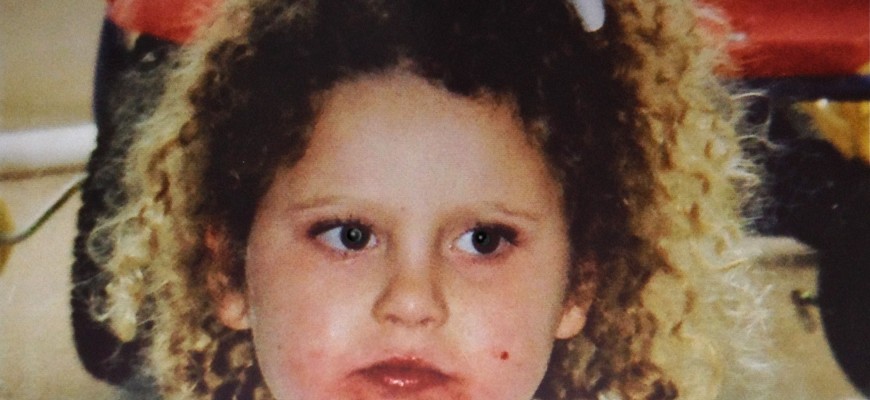 tiara with her eczema